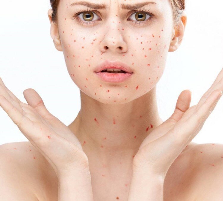 Facial pimples caused by shaving