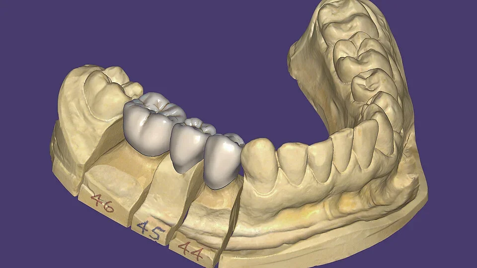 Conception de couronnes dentaires dans le logiciel Exocad DentalCAD