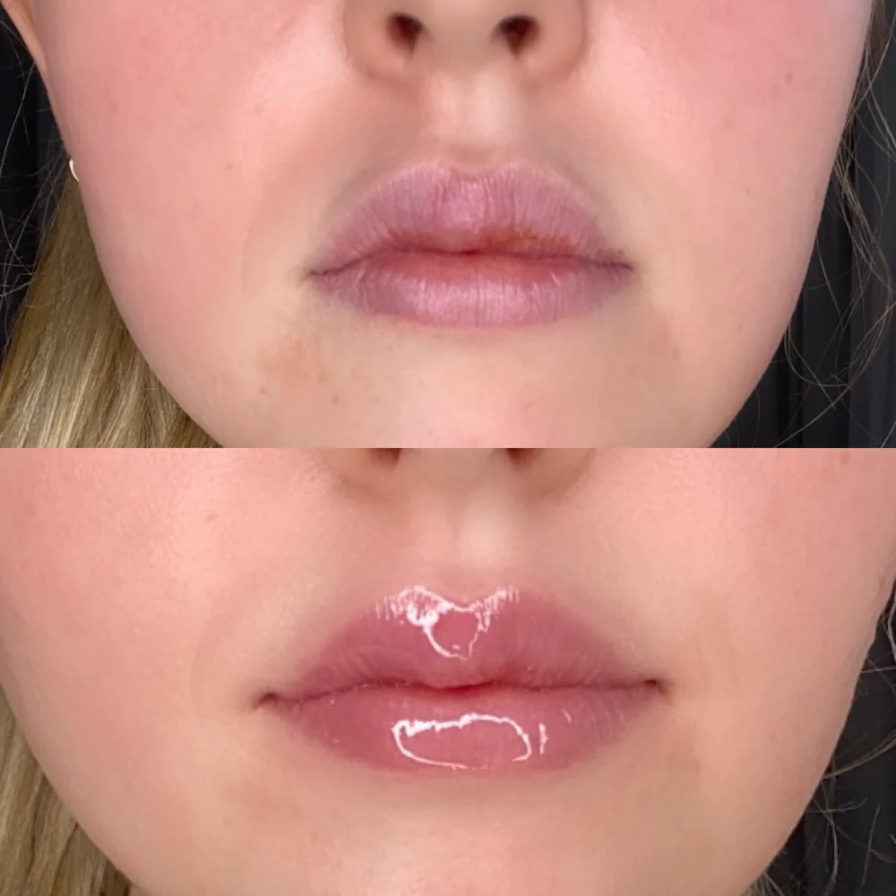 Abigail’s lips right before (above) and 15 minutes after (below) applying Dr. Devgan’s Platinum Lip Plump.