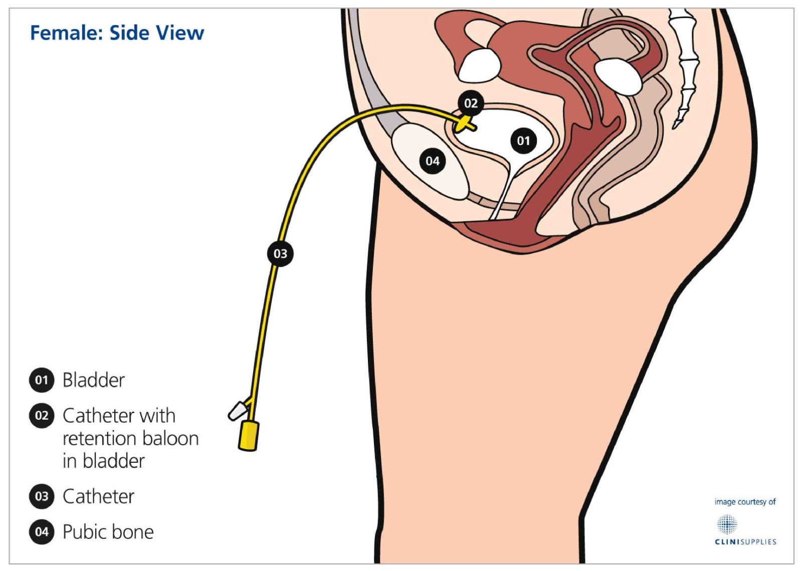 Bladder filling catheter