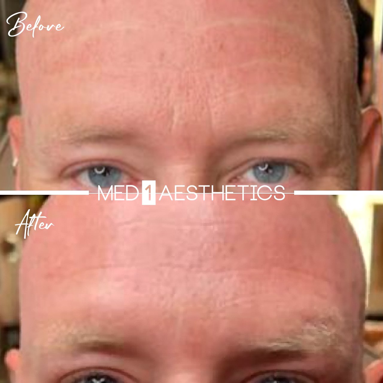 Botox Daxxify Dysport Jeuveau Before And After Ann Arbor