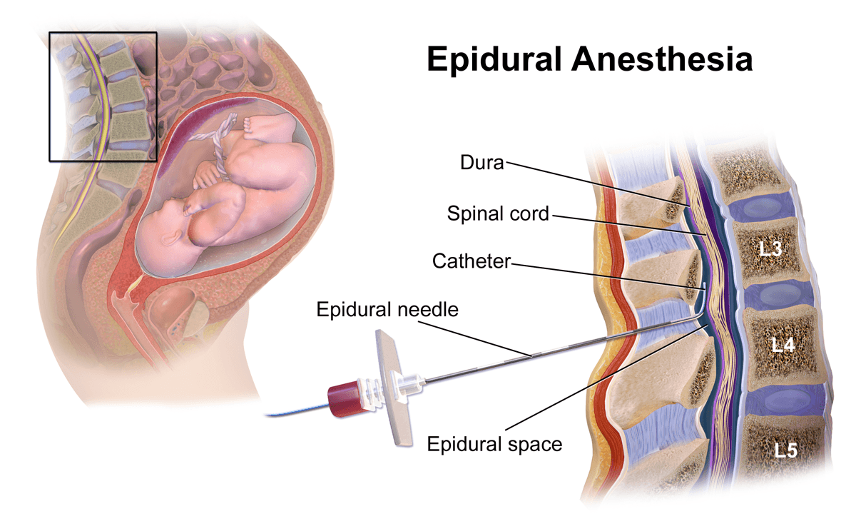 Epidural_Anesthesia.png