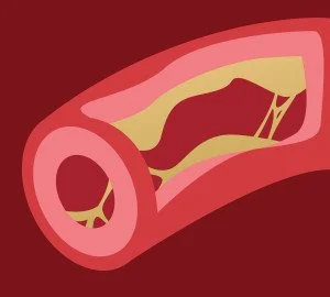Artery