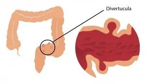 Divertucula