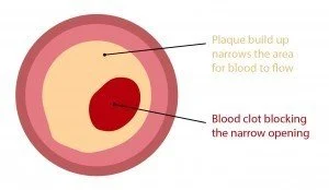 Blood Clot