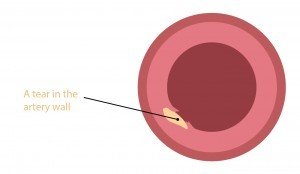 Tear in artery
