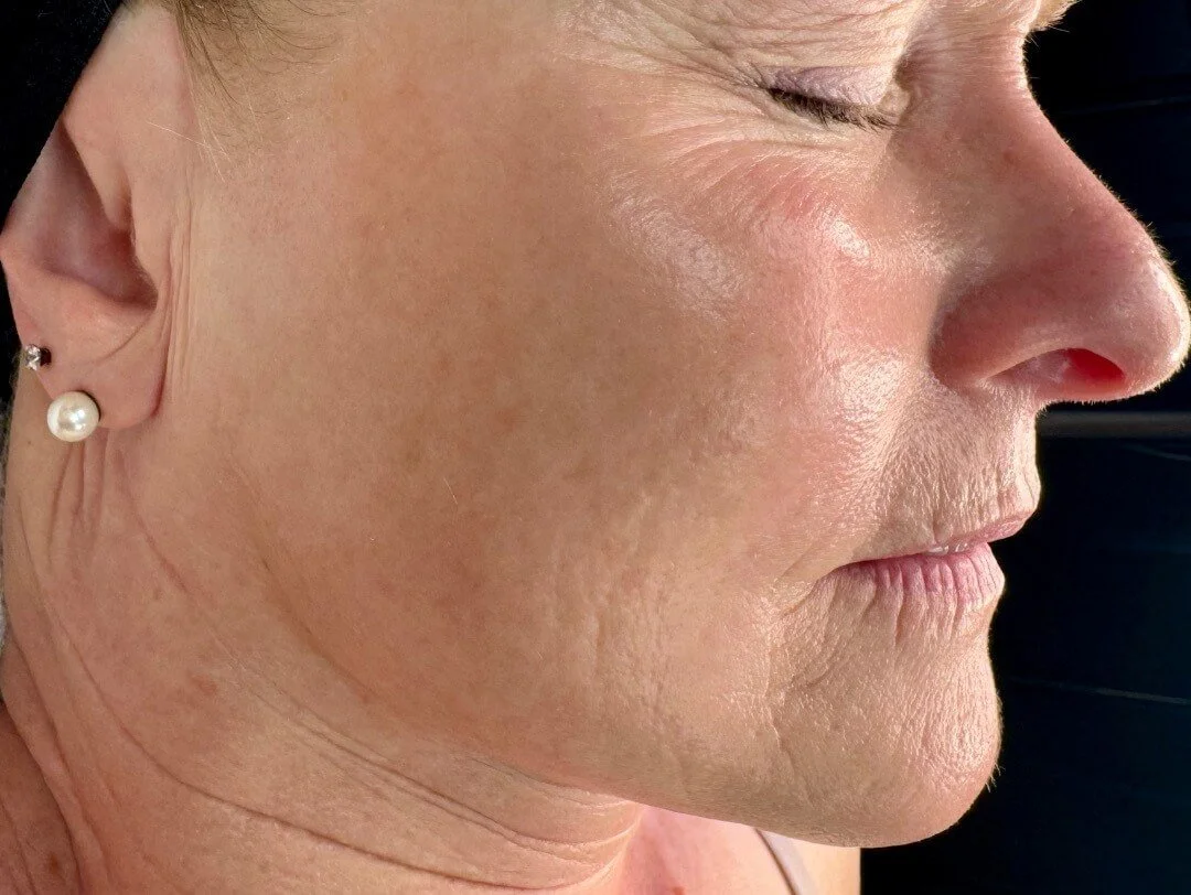 Skin after treatment