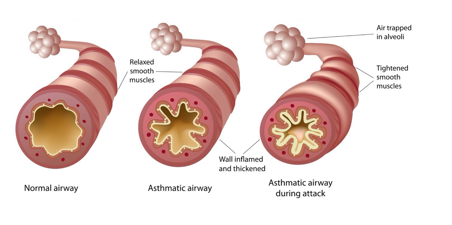 Что вызывает бронхиальную астму. Бронхиальная астма. Бронхиальная астма неаллергическая форма. Что вызывает бронхиальную астму. Эндогенные факторы бронхиальной астмы.
