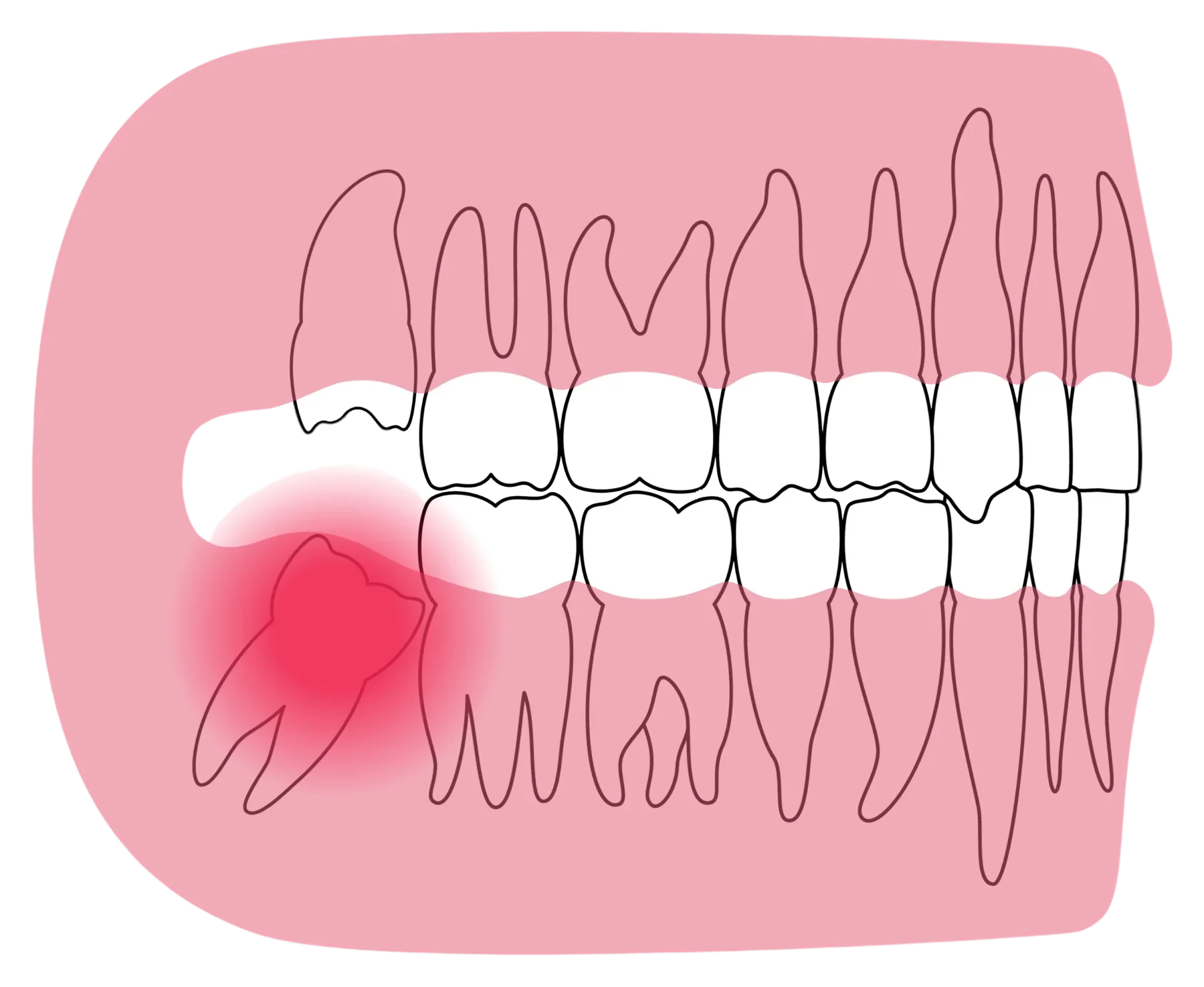 Illustration of an impacted wisdom tooth under the gum near the back molars