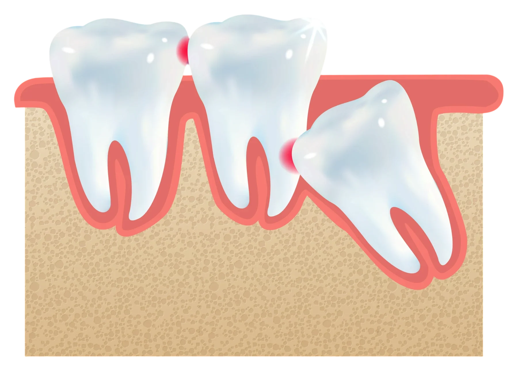 Diagram showing a tilted impacted wisdom tooth pushing toward the tooth in front