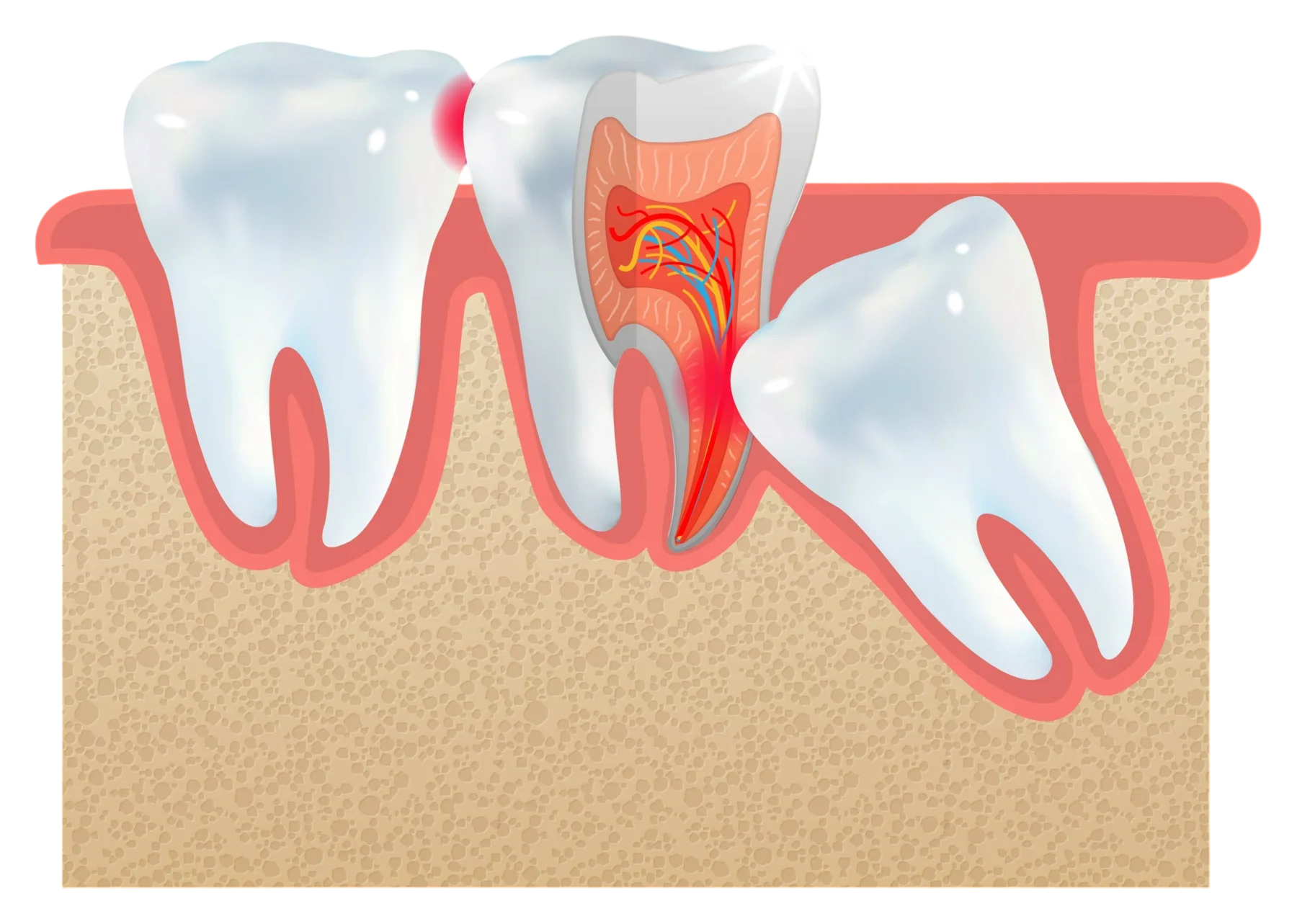 Diagram showing a tilted wisdom tooth and decay risk on the tooth in front