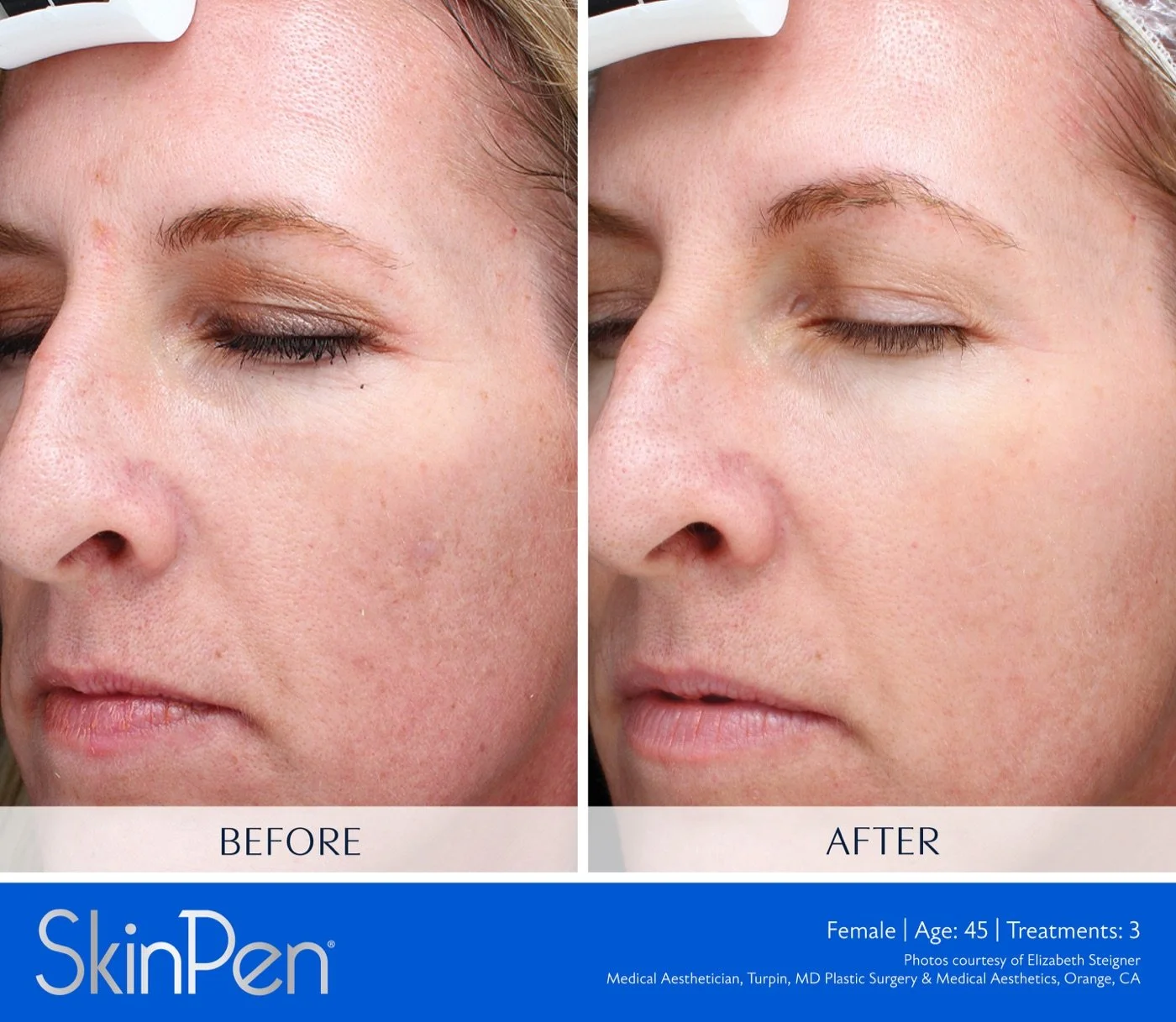 SkinPen before-and-after result after three treatments, female patient age 45