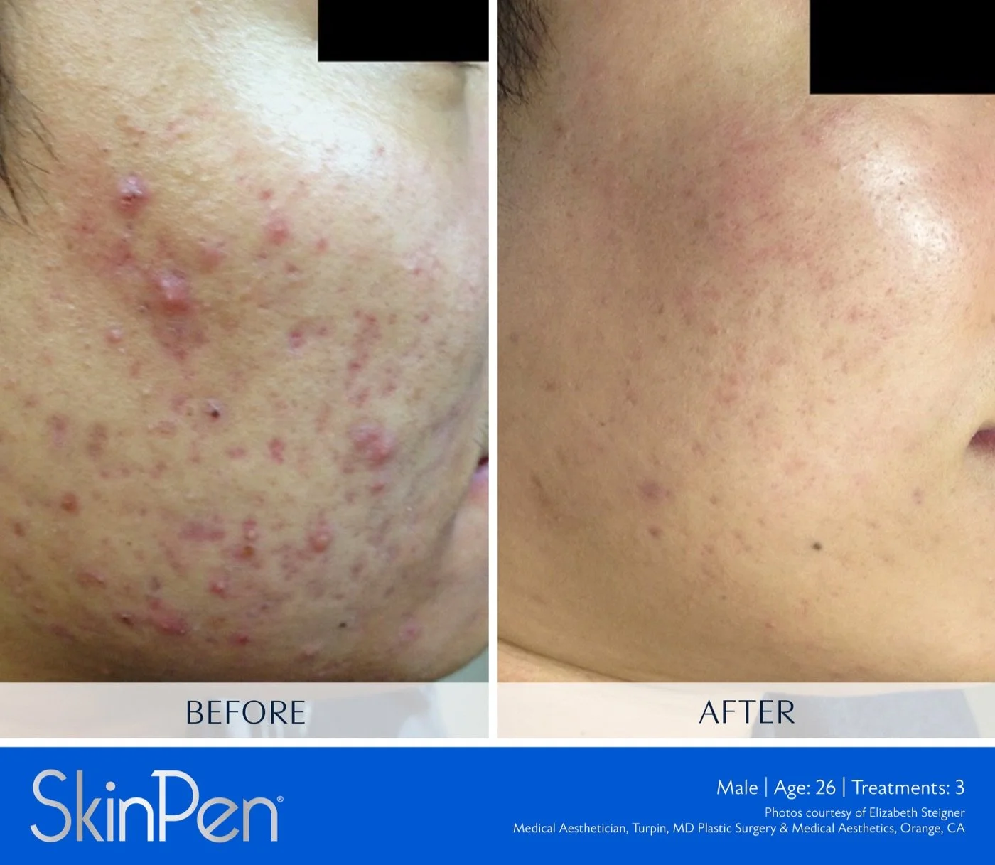 SkinPen before-and-after result after three treatments, male patient age 26
