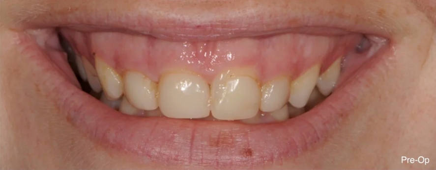 Before: poor cosmetic dentistry outcome with opaque, bulky veneers