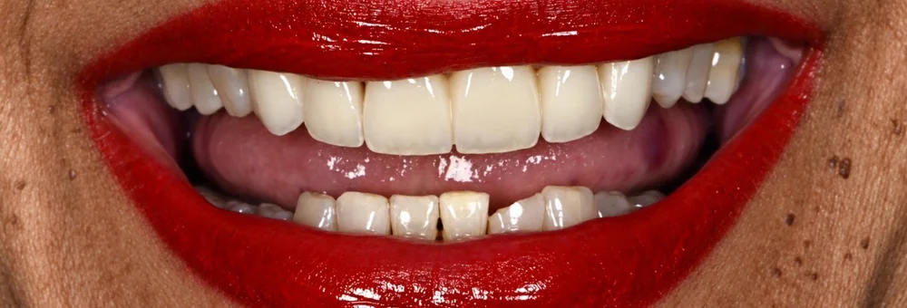 After: porcelain-fused-to-zirconia bridge from #8 to #11 and veneers on #6 and #7 in one even shade