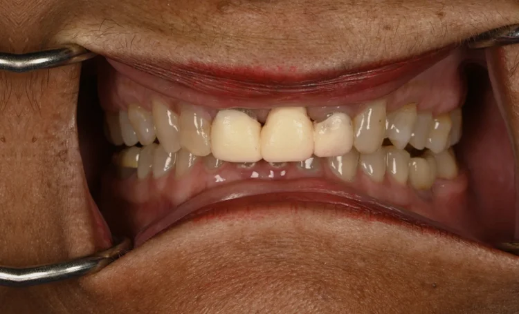 Before treatment: old opaque crowns on the upper front teeth, a failing upper left central incisor and dark spaces at the gumline