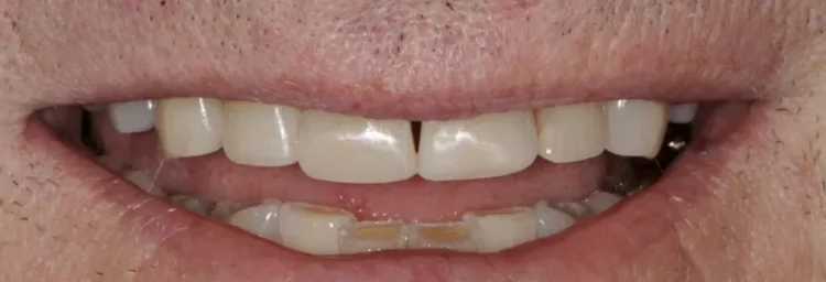 After: composite bonding and recontoured, rounded edges for a younger-looking smile