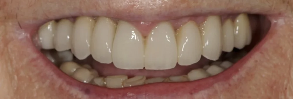 After: new implant-supported PFZ bridges and crowns with a contoured gumline