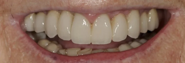 After: failed crowns and bridges replaced with implants and new porcelain-fused-to-zirconia crowns
