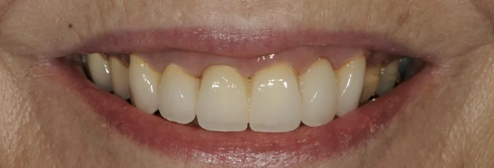 After: four upper front teeth replaced with a fixed bridge