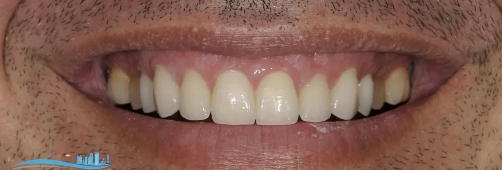 After: worn teeth rebuilt with porcelain-fused-to-zirconia restorations
