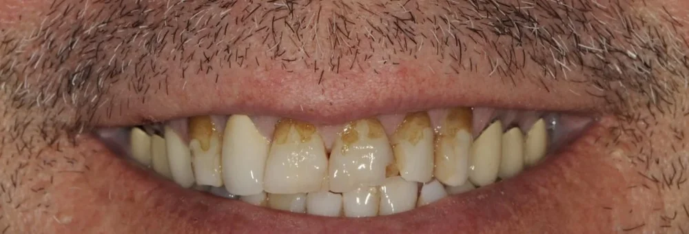 Upper front teeth before treatment, short in appearance with stained bonding along the gumline