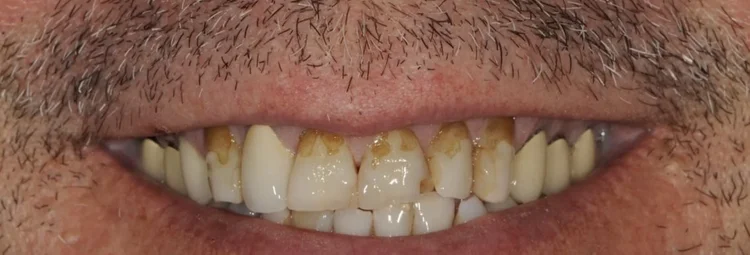 Before: short upper front teeth with stained, failing bonding along the gumline