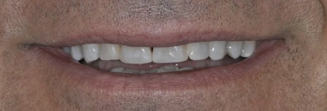 Chipped front teeth in Jacksonville repaired with tooth-colored bonding for an even smile line