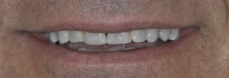 After: chips repaired with composite bonding for an even smile line