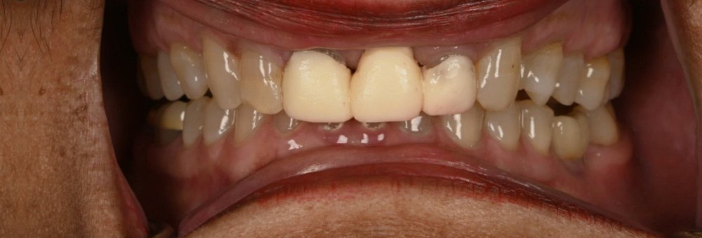 Before: fractured upper left front tooth under an old opaque crown, with mismatched crowns and dark gaps at the gumline