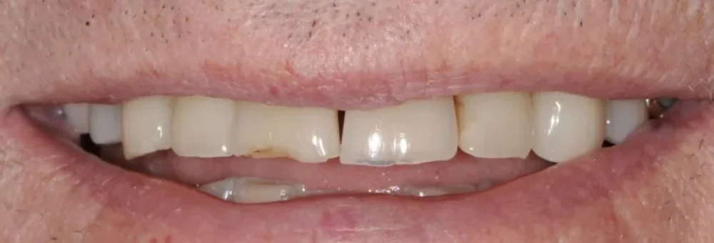Before: chipped, worn upper front teeth with squared-off corners