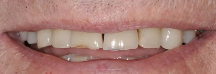 Before: chipped, worn upper front teeth with squared-off corners