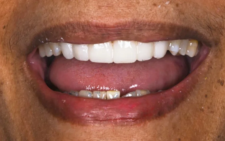 Temporary bridge and veneers on the upper front teeth during treatment, before the final porcelain-fused-to-zirconia work