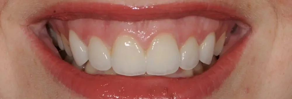 After: balanced gumline and layered e.max restorations with natural incisal translucency