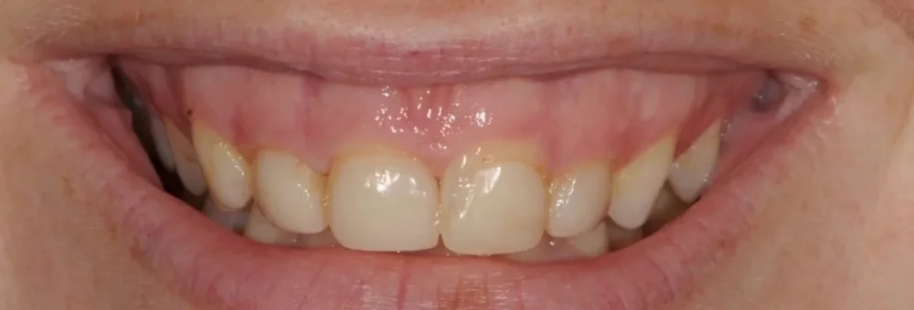 Before: gummy smile with short, uneven front teeth