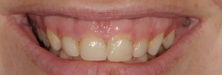 Before: gummy smile with short, uneven front teeth
