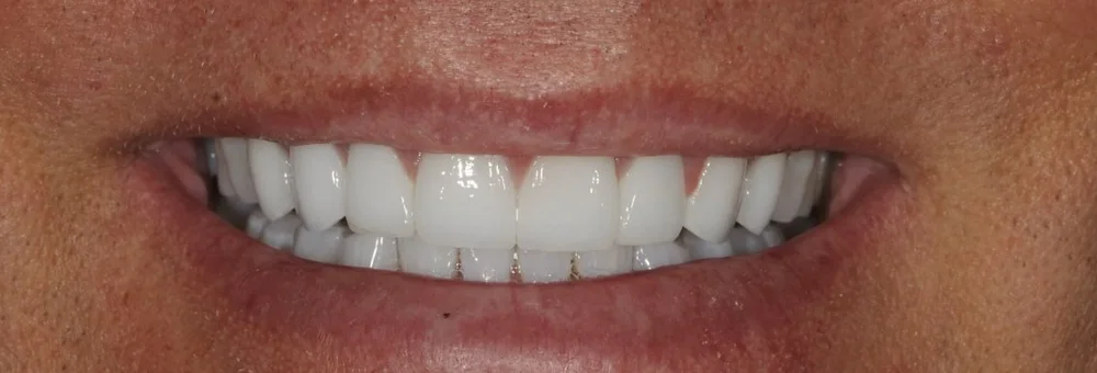 After: full upper arch restored with crowns and three-quarter crowns