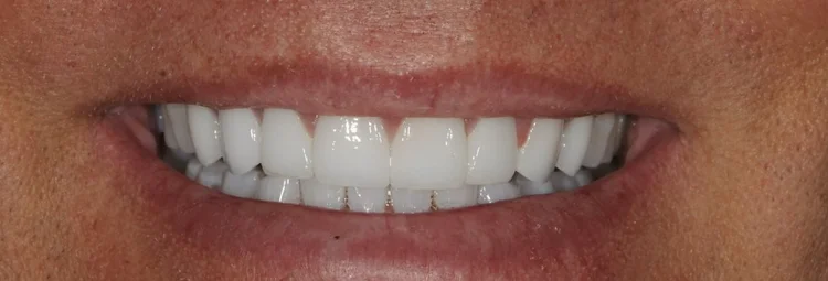 After: upper teeth rebuilt with full and three-quarter crowns after grinding wear