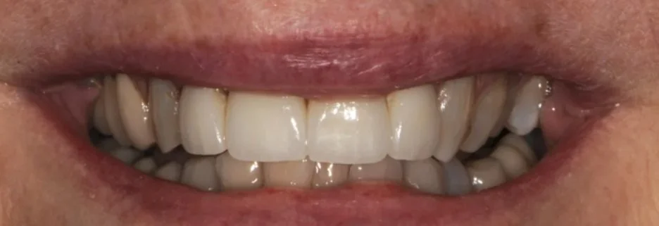 After: upper front teeth restored with veneers in a balanced shape and shade
