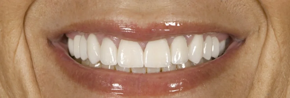 After: full zirconia crowns with natural surface texture and secondary anatomy