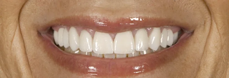 After: full zirconia crowns with natural surface texture and secondary anatomy