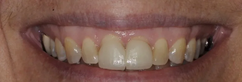 Before: two front teeth lighter than the yellowed teeth beside them