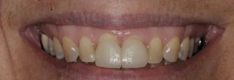 Before: two front teeth lighter than the yellowed teeth beside them