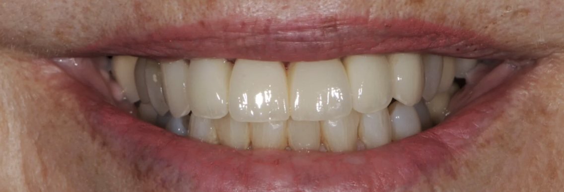 Natural-looking front dental bridge in Jacksonville after a second-opinion redo of bulky, opaque restorations