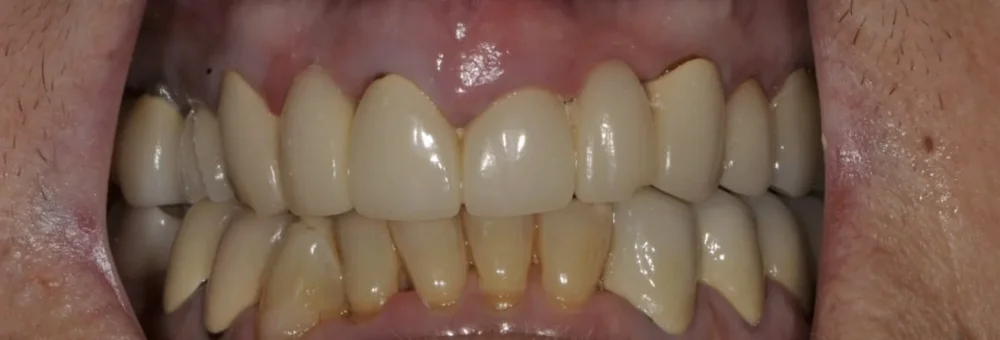 Before: failing crowns and bridges with worn, discolored upper teeth