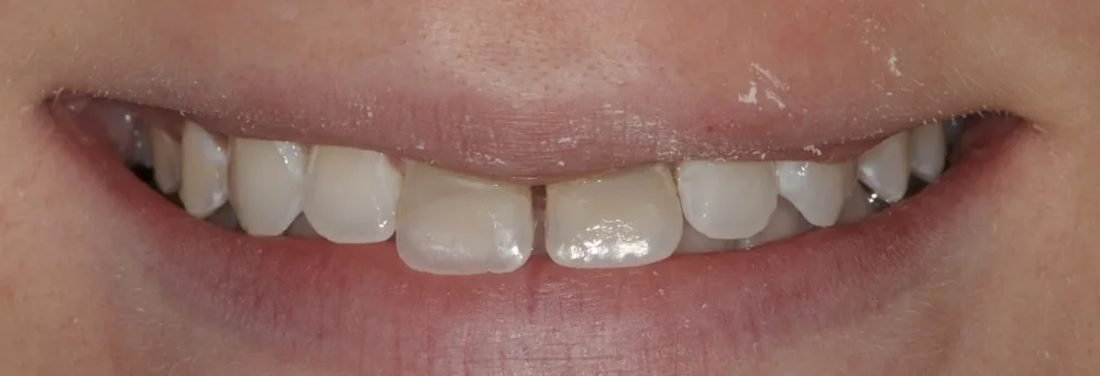 Upper front teeth before treatment, discolored and mismatched with a gap after childhood dental trauma
