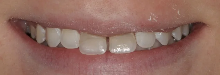Before: gaps and mismatched front teeth after childhood trauma