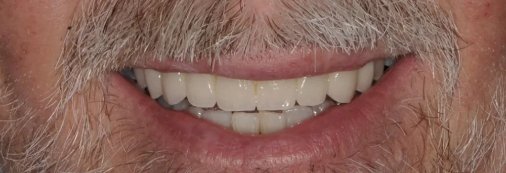 After: long-span porcelain-fused-to-zirconia fixed bridge, 10 years in service