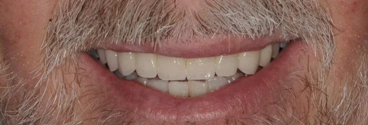 After: long-span porcelain-fused-to-zirconia dental bridge, still sound ten years after head and neck radiation