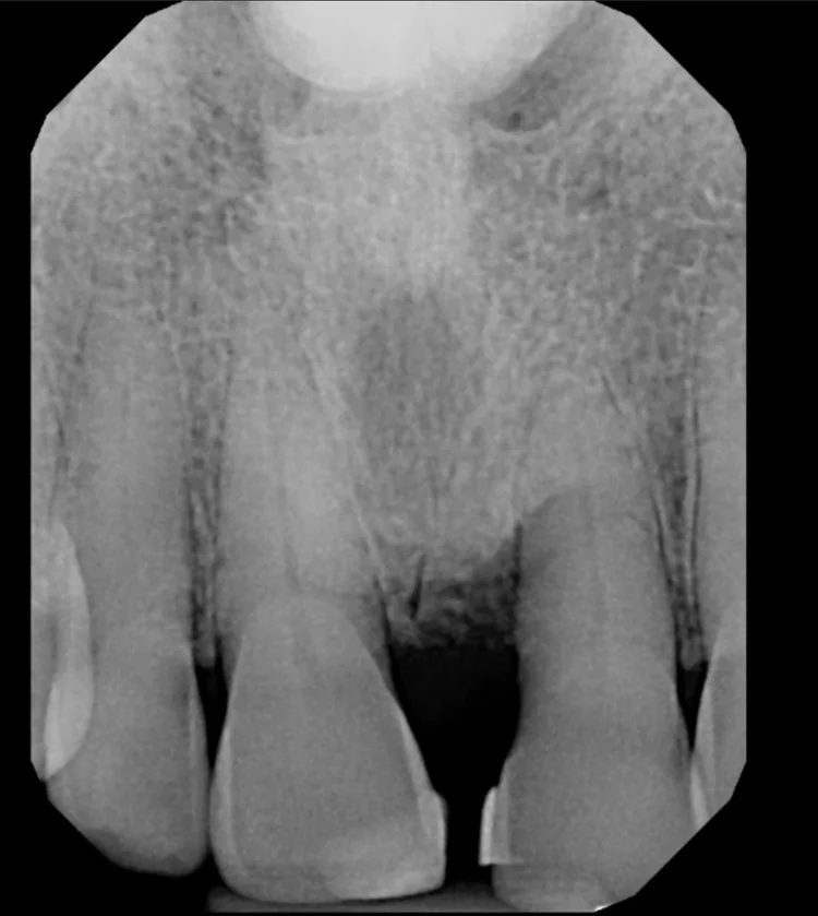 Dental x-ray of the upper front teeth showing bone loss around the fractured upper left central incisor